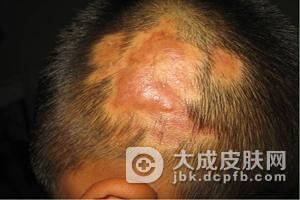 有哪些症状可表明自己得了头癣疾病