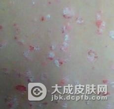 女性银屑病的原因有哪些
