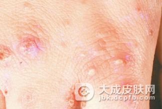 疥疮的危害主要表现在哪