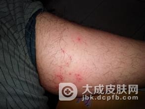 下巴长粉刺怎么处理比较好