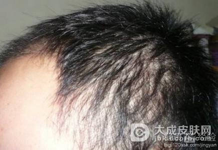脱发患者要谨防陷入治疗误区