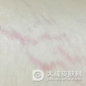 皮肤萎缩纹怎么治疗呢
