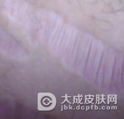 应该如何预防萎缩纹