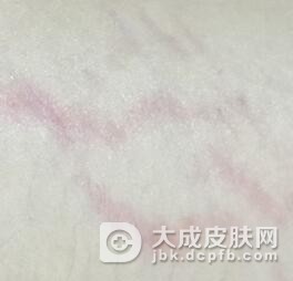 萎缩纹的混淆疾病
