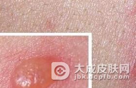 单纯性疱疹有哪些危害