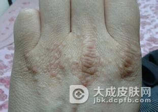 手部湿疹具有哪些常见的症状表现呢