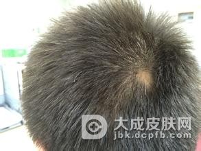 斑秃患者在平时的饮食上需要注意什么呢