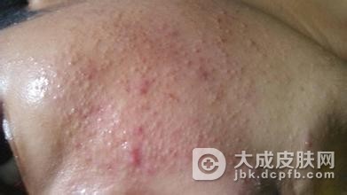 寻常痤疮患者应如何自我调养