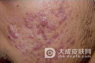 寻常痤疮的症状表现都有什么呢