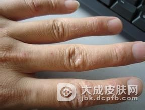 夏季预防手足癣疾病措施有哪些