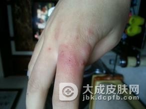 冻疮初期症状详细有哪些