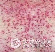 糠秕孢子菌毛囊炎要怎么鉴别诊断