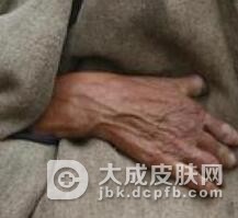 麻风病是怎样发生传染的