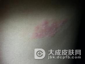 带状疱疹病发的“引子”是什么