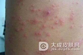 治疗皮肤过敏的药物需要慎重