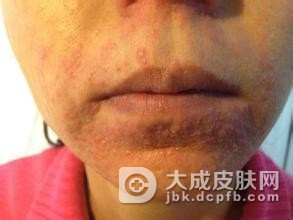预防小儿口周皮炎