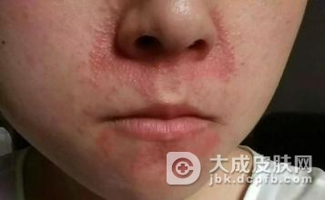 口周皮炎的发病特点有哪些