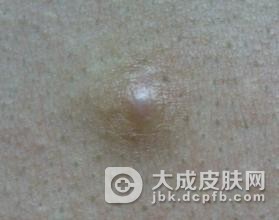 外阴毛囊炎要如何诊断呢