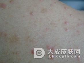 毛囊炎发病时有哪些症状