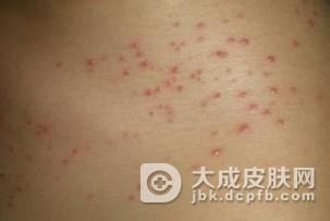毛囊炎治疗期间要注意什么