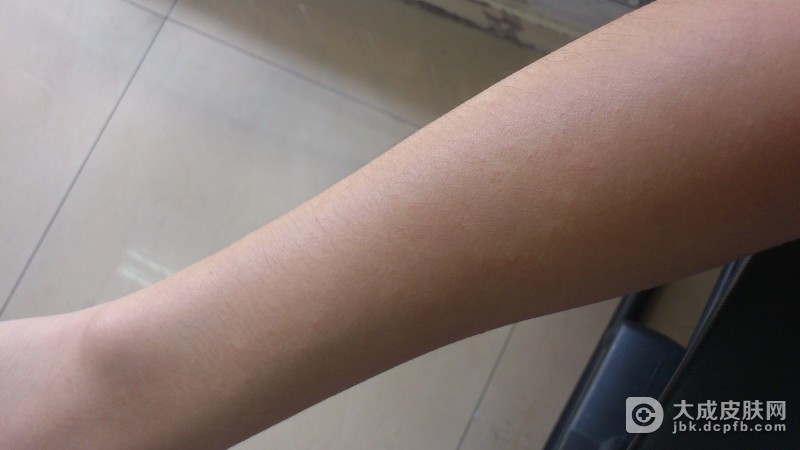 婴儿长湿疹怎么样护理