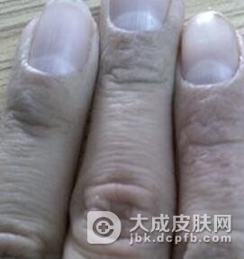 夏季手癣怎样防治