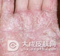 手癣的皮肤表现有哪些