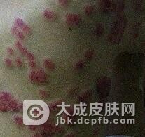 女性一期梅毒如何治疗