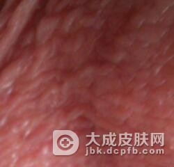 阴囊湿疹用什么药物治疗好