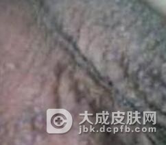 阴囊长湿疹怎样护理最好