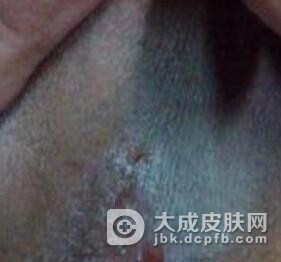 男性怎么远离阴囊患湿疹