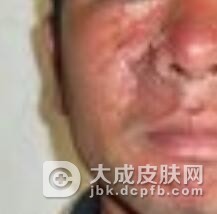 结节性硬化症的诊断标准是什么