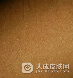日光性皮炎应该怎么办才好呢