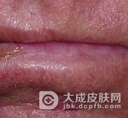 光化性唇炎并发症有哪些