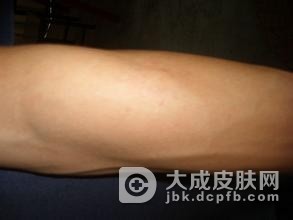 常见的四种药疹特点会有什么