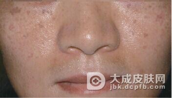 黄褐斑的预防工作都有哪些呢