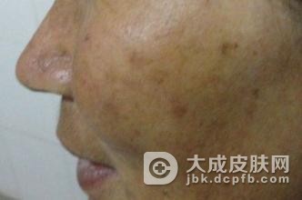预防黄褐斑的措施都有什么呢