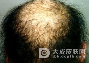 儿童头癣的好发时期是什么季节呢