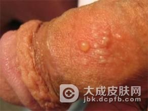 男性生殖器疱疹有什么严重危害