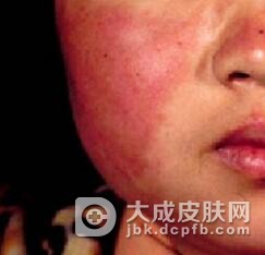 系统性红斑狼疮护理是怎样的呢
