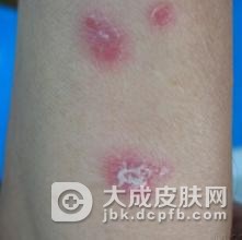 红皮病型银屑病基本常识有哪些