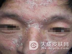 银屑病患者在日常饮食中不能偏食