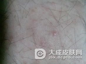 疥疮疾病的预防措施有什么