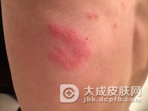 小儿疥疮的防治措施具体的应该有哪些方面