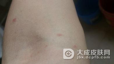 得了疥疮要注意哪些生活习惯