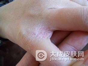 疥疮的护理都有哪些呢