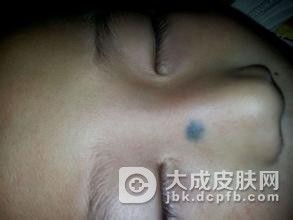 长了青胎记产生的危害会有哪些