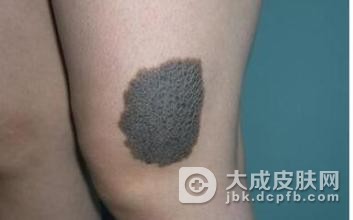 红色胎记有什么样的表现呢