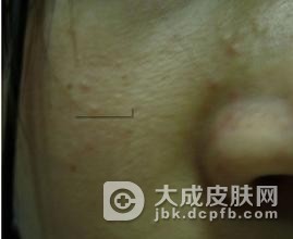 粉刺性痤疮的诊断依据有哪些呢