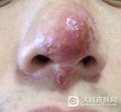 酒渣鼻这种病会不会传染